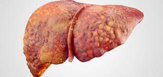 علامات خفية في البول تشير إلى تلف الكبد