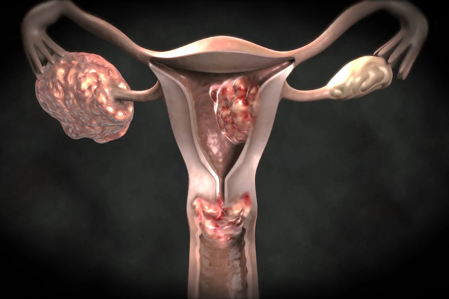 سرطان الرحم: أعراض صامتة تكشف عن خطر كبير