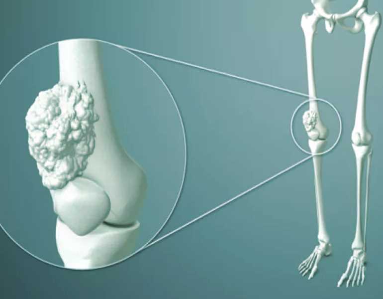 أبرز 5 علامات مبكرة تكشف إصابتك بسرطان العظام