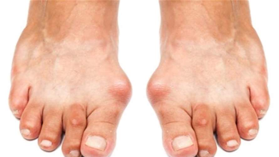 ورم إبهام القدم.. مشكلة هيكلية خفية قد تتطور إلى تشوه دائم