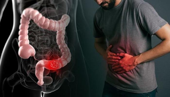 علامات الإمساك المزمن ومتى يجب مراجعة الطبيب..