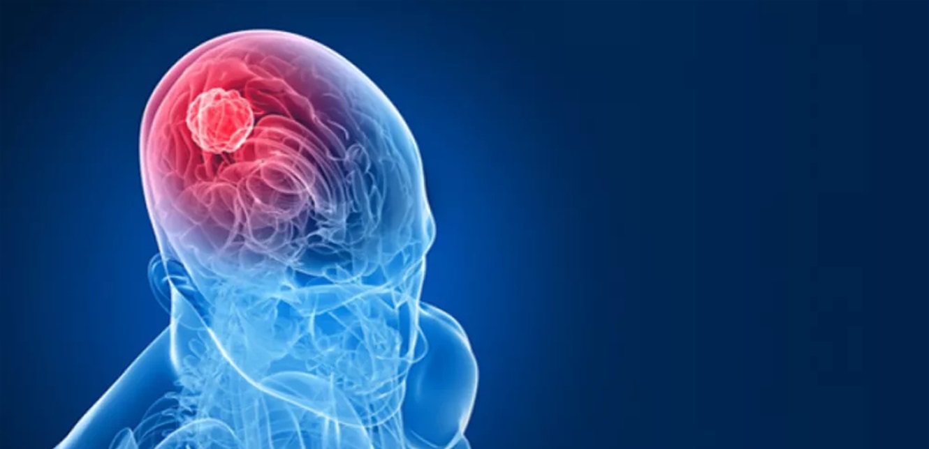 أعراض شائعة قد تُنذر بسرطان الدماغ.. تجاهلها قد يؤخر التشخيص