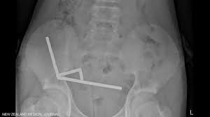 طفل في نيوزيلندا يبتلع 100 قطعة مغناطيسية من موقع تيمو