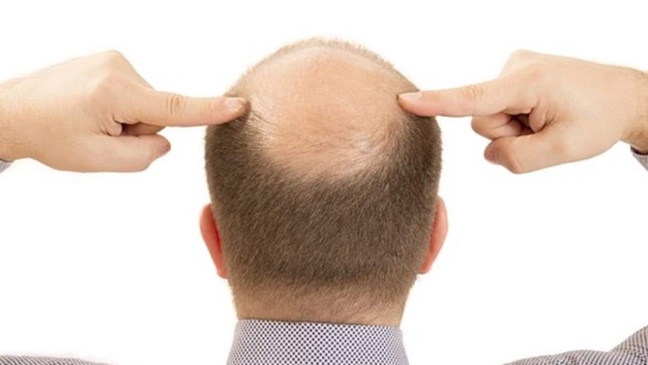 مصل جديد يعيد نمو الشعر خلال 20 يومًا فقط