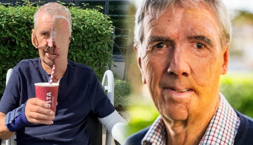 أول وجه مطبوع بتقنية ثلاثية الأبعاد يعيد الحياة لرجل بريطاني